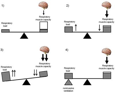 Non-invasive Ventilation in Children With Neuromuscular Disease